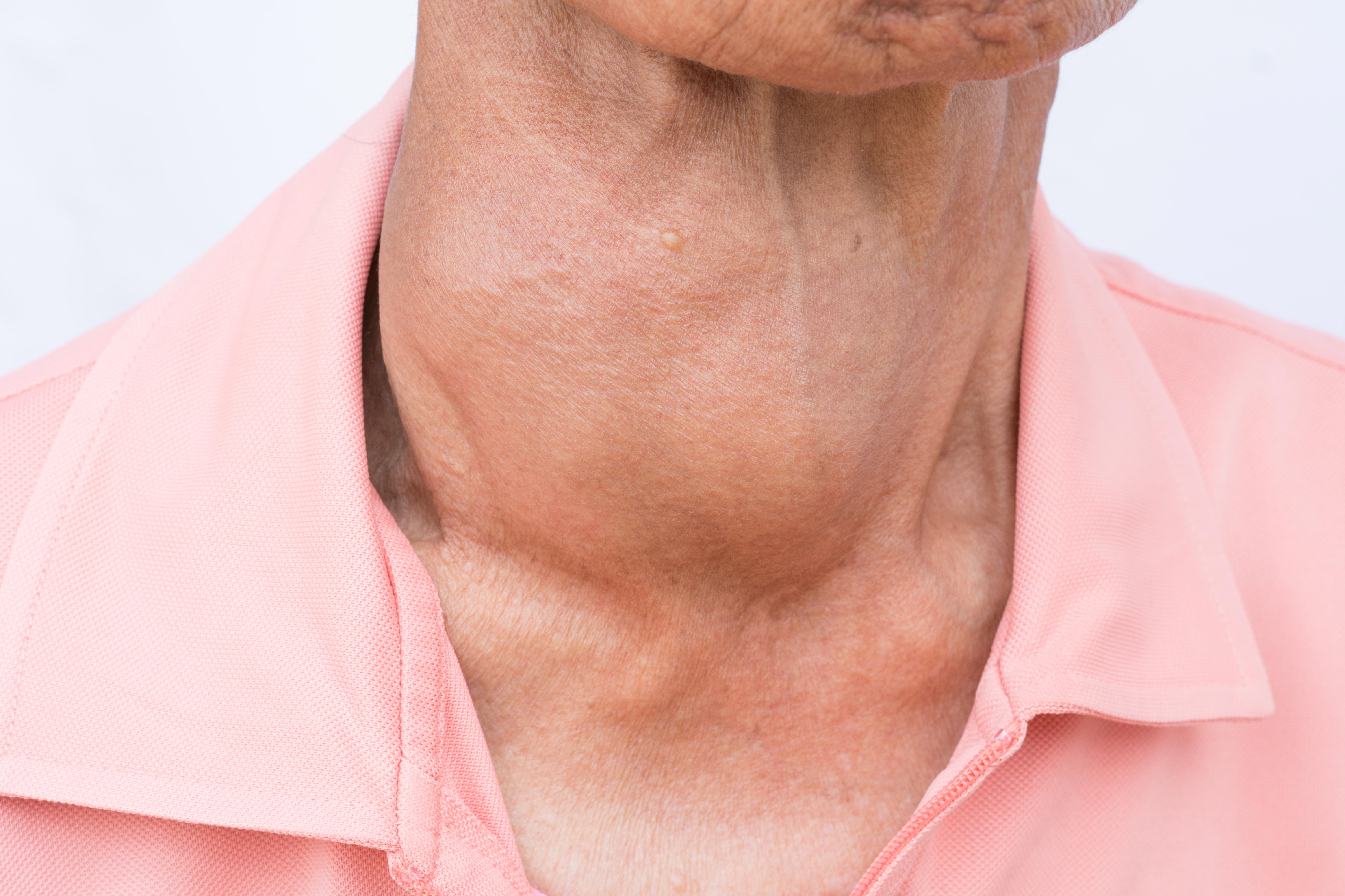 Узловой зоб киста щитовидной железы