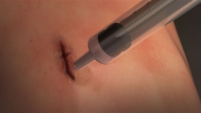 SUPER FLEXIBLE SURGICAL  GLUE (MeTro) SEALS WOUNDS IN SECONDS